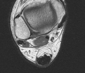 Tendoachilles Noninsertional Tendonitis Axial MRI